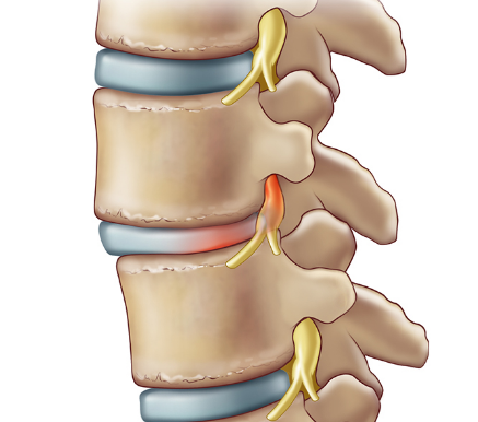 Spondylolisthesis